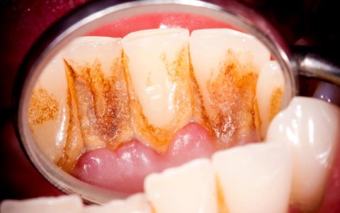 Main Cause of Gum Disease: Bacteria